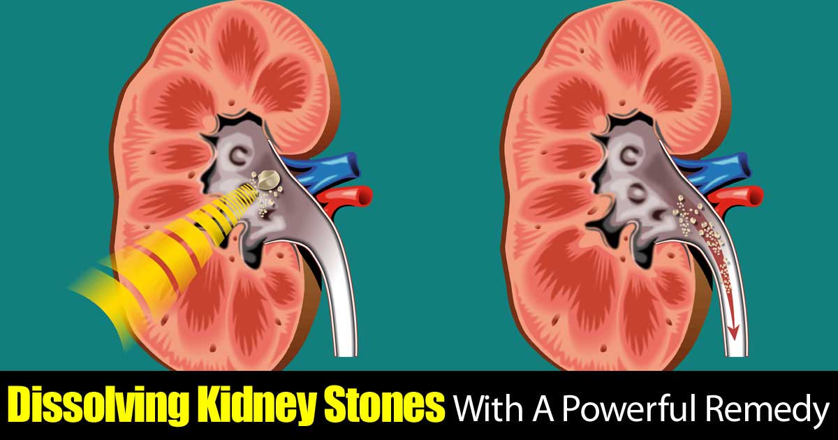 Dissolve Kidney Stones With A Powerful Effective Remedy
