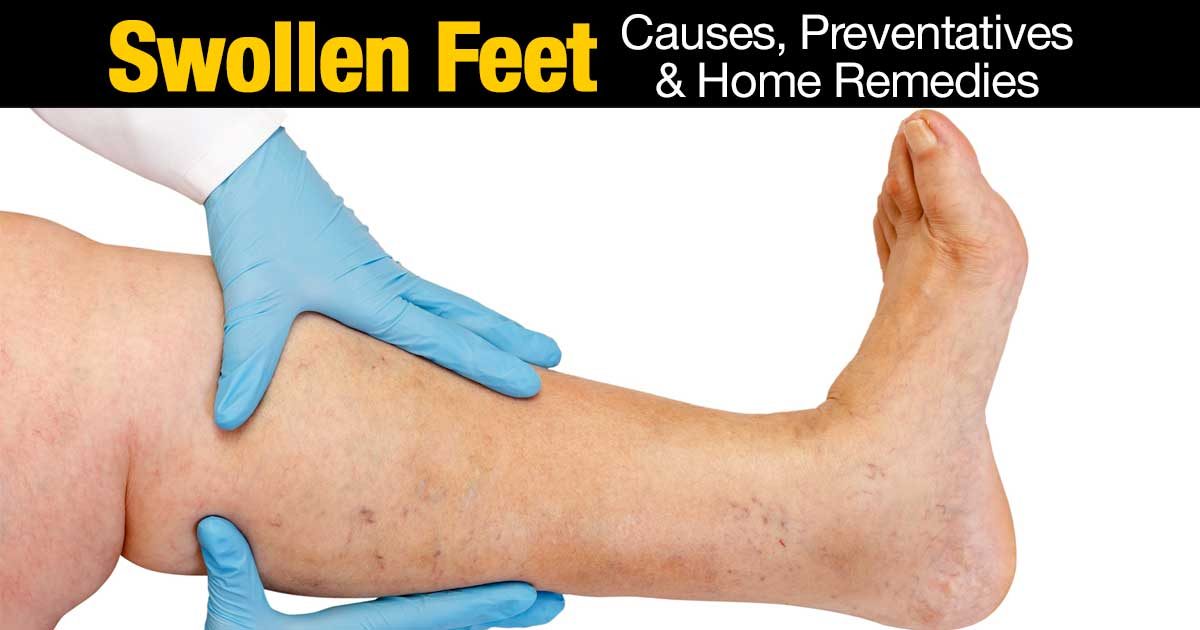 Swollen Feet Causes, Preventatives & Home Remedies